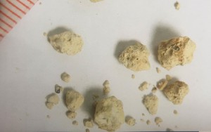 Ăn mặn, ít uống nước là đang ‘nuôi’ sỏi niệu