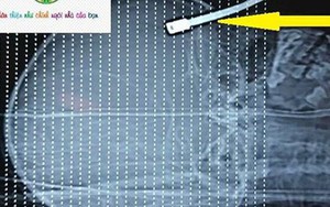 Hãi hùng thanh sắt xuyên vào ổ mắt, vô não bé 5 tuổi