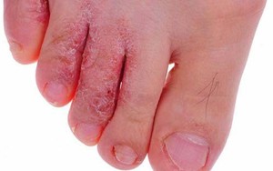 Ai dễ bị nấm chân?