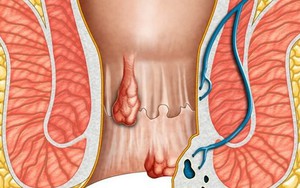 Hơn 1 nửa dân số mắc bệnh 'khó nói' này, đâu là dấu hiệu bạn phải tới viện ngay?