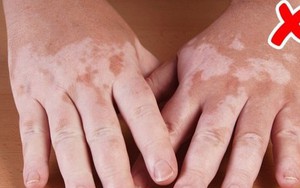 Cẩn thận với những bệnh nguy hiểm được thông báo qua dấu hiệu bất thường trên làn da