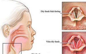 Cách giữ giọng không khàn