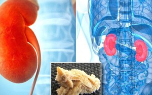 Bệnh sỏi thận có nguy hiểm không? Chớ chủ quan với 4 biến chứng này