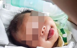 Khối ung thư lạ lấp đầy miệng bé sơ sinh
