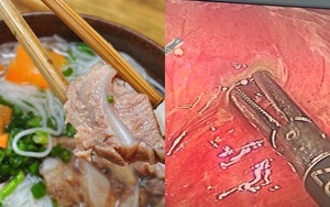 Ăn bún sườn quá nhanh, người phụ nữ Hà Nội bị thủng ruột