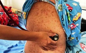 Cảnh báo nhiều trẻ mắc sởi biến chứng nặng vì không tiêm vắc xin
