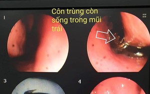 Bắt con bướm đang giãy trong mũi bệnh nhân