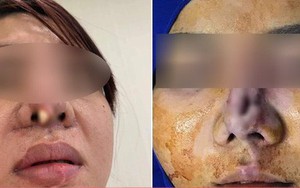 Góc kinh dị: Bà mẹ trẻ đi nâng mũi, nhưng bị lòi cả sụn ra ngoài khiến hội chị em hoang mang sợ hãi