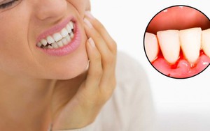 Cảnh báo khi bạn bị chảy máu chân răng