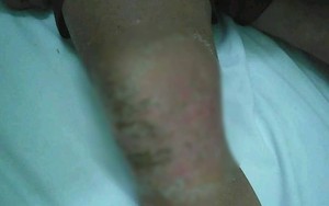 Đầu gối sưng húp vì tự ý đắp lá cây chữa bệnh