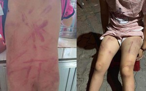 Xôn xao việc bà cố đánh cháu gái 6 tuổi bầm tím người ở Quảng Nam
