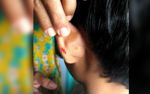 Malaysia: Không làm bài tập về nhà, học sinh bị thầy giáo phạt bằng cách dập ghim vào tai