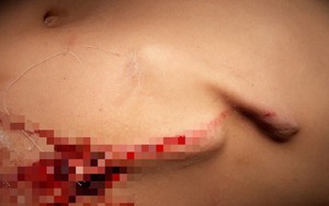Bé trai 8 tuổi bị gốc cỏ voi đâm thủng bụng