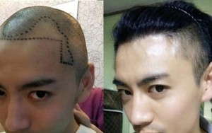 "Đại dịch" hói đầu tấn công đàn ông Trung Quốc, dịch vụ chăm sóc và cấy tóc mọc lên như nấm sau mưa