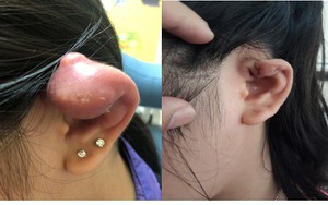 Bé gái 12 tuổi nổi u, mủ sau bấm lỗ tai