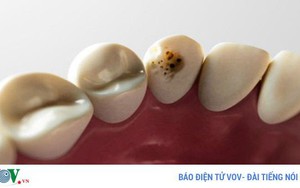Những thực phẩm tuyệt vời giúp phòng ngừa sâu răng
