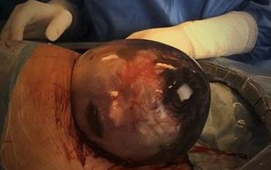 Em bé ngủ say sưa dù đã ra khỏi bụng mẹ, mãi đến khi bác sĩ rạch túi ối mới bàng hoàng biết "nơi ở" của mình bị thay đổi