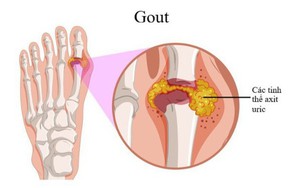 Bệnh gout có di truyền?