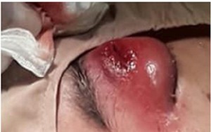 Sốc: Bé trai 14 tuổi nhiễm vi khuẩn hầu họng gây hoại tử hốc mắt, áp xe trong hộp sọ