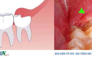Bệnh viêm lợi và những nguy hiểm khó lường