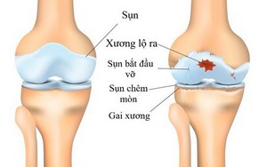 Cách kiểm soát đau khớp khi “trái gió trở trời”