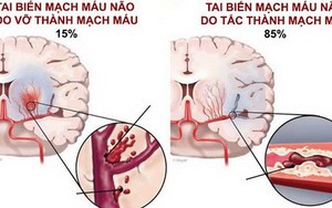 Tai biến mạch máu não: Cấp cứu thế nào để tránh tử vong?