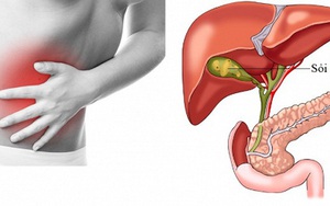 Lấy 800 hạt 'trân châu' trong túi mật người đàn ông