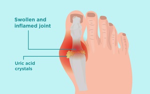 Công thức '3 nhiều 3 ít' để hạ Axit Uric trong máu: Người trẻ hay già đều nên quan tâm