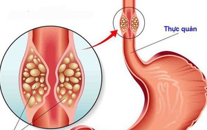 Phát hiện ung thư nhờ miếng thịt ngan: Bác sĩ nhắc khi ăn có dấu hiệu này phải khám ngay