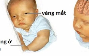 Bé 3 tuổi bại não từ di chứng vàng da sơ sinh: Ranh giới mong manh nhận biết vàng da bệnh lý