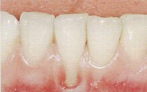 Làm gì khi bị tụt lợi?