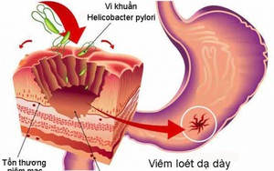 Nhiễm HP bao tử là gì?