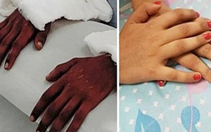 Cô gái trẻ được ghép bàn tay của một nam thanh niên da đen, hơn 2 năm sau bác sĩ kinh ngạc khi thấy nó "chuyển màu"