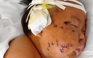 Em bé từng bị mẹ đâm 90 nhát kéo vào mặt vì cắn ti mẹ khi đang bú giờ ra sao?