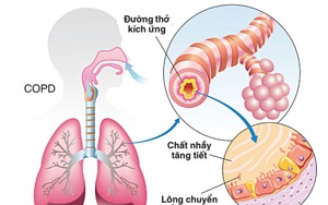 Phòng ngừa bệnh phổi tắc nghẽn mạn tính