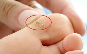 Cách chữa mụn cóc