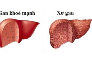 Dấu hiệu nhận biết xơ gan