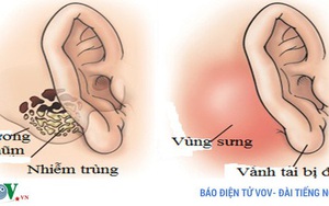 Tai có mùi hôi thối - triệu chứng của nhiều bệnh lý nguy hiểm