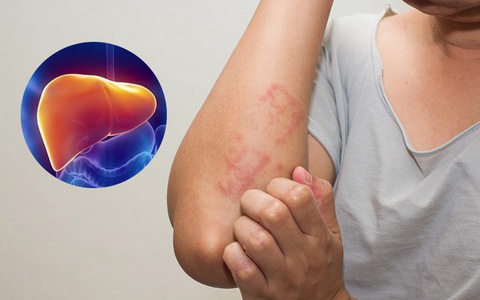 Dấu hiệu gan suy yếu - Nhận biết 4 dấu hiệu điển hình 7 Dấu hiệu gan suy yếu - Nhận biết và xử lý kịp thời để bảo vệ sức khỏe