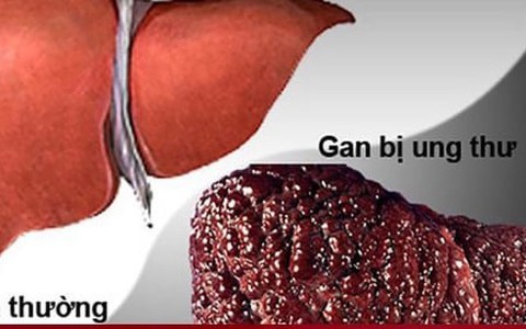 5 dấu hiệu cảnh báo ung thư gan sớm, mơ hồ cũng không nên bỏ qua