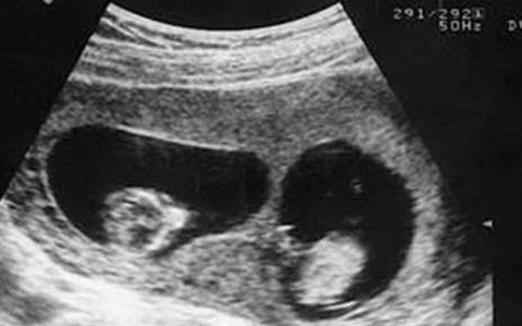 Siêu âm là cách tuyệt vời để khám phá thế giới nhỏ bé của thai nhi trong bụng mẹ. Hãy xem những hình ảnh siêu âm để tìm hiểu những chuyển động và biểu hiện đáng yêu của bé.
