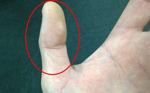 đốt ngón tay cái: Tin tức, Video, hình ảnh đốt ngón tay cái