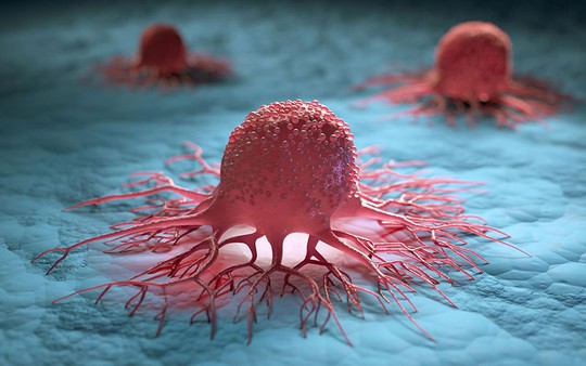 5 người trong gia đình cùng mắc ung thư đại trực tràng: Bác sĩ ung bướu chỉ ra “thủ phạm”