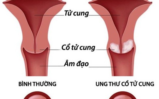 8 dấu hiệu sớm của ung thư cổ tử cung chị em cần đặc biệt lưu ý