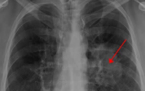 Người phụ nữ 37 tuổi qua đời sau 2 tuần phát hiện ung thư phổi, bác sĩ cảnh báo 1 dấu hiệu hầu hết mọi người đều bỏ qua