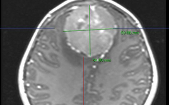 Có 1 dấu hiệu kéo dài nhiều tuần, bé gái 9 tuổi được phát hiện mắc u màng não kích thước lớn