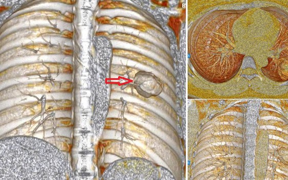 Xét nghiệm có chỉ số mang thai, cô gái ngỡ ngàng khi “thủ phạm” là ung thư tạo triệu chứng đánh lừa