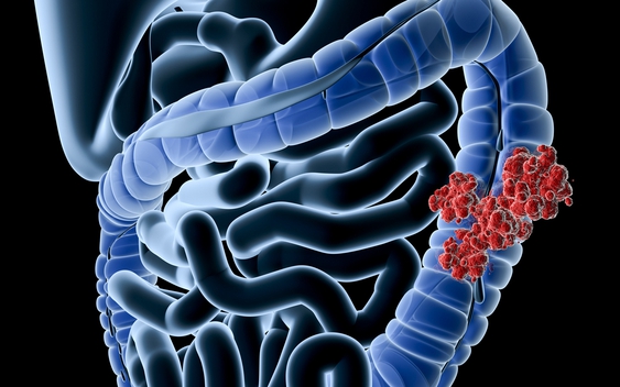 Muốn ngăn chặn ung thư đại tràng, đây là việc cần làm đầu tiên