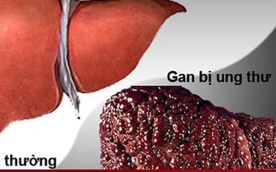 5 dấu hiệu cảnh báo ung thư gan sớm, mơ hồ cũng không nên bỏ qua