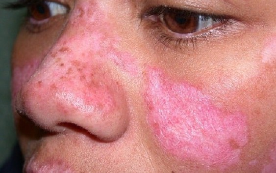 Cô gái Huế đột ngột qua đời trước ngày cưới nửa tháng do mắc bệnh lupus ban đỏ: Cảnh báo 1 nhóm phụ nữ nguy cơ cao mắc bệnh
